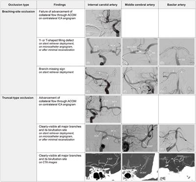 Angiographical Identification of Intracranial, Atherosclerosis-Related, Large Vessel Occlusion in Endovascular Treatment